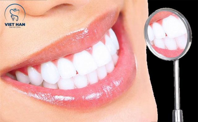 Tẩy trắng răng là gì?