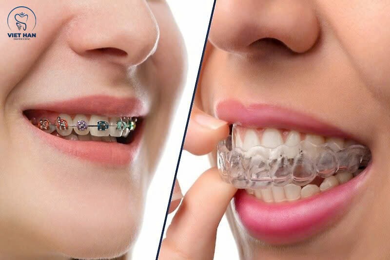 So sánh niềng răng mắc cài và niềng khay trong suốt? Nên chọn loại nào?