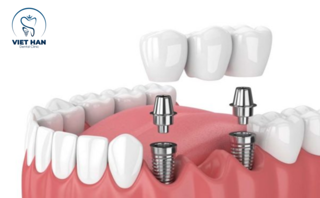hình ảnh cắm implant