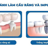 So sánh trồng Implant và cầu răng sứ