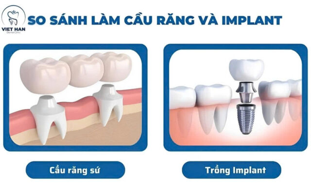 So sánh trồng Implant và cầu răng sứ