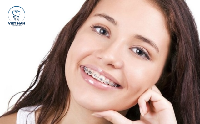 Niềng răng có hóp mặt không?
