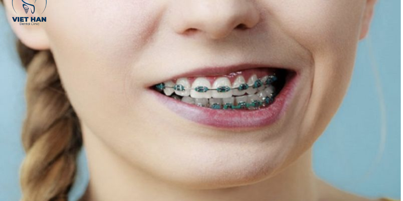 Niềng răng bị hóp má: Sự thật hay hiểu lầm?