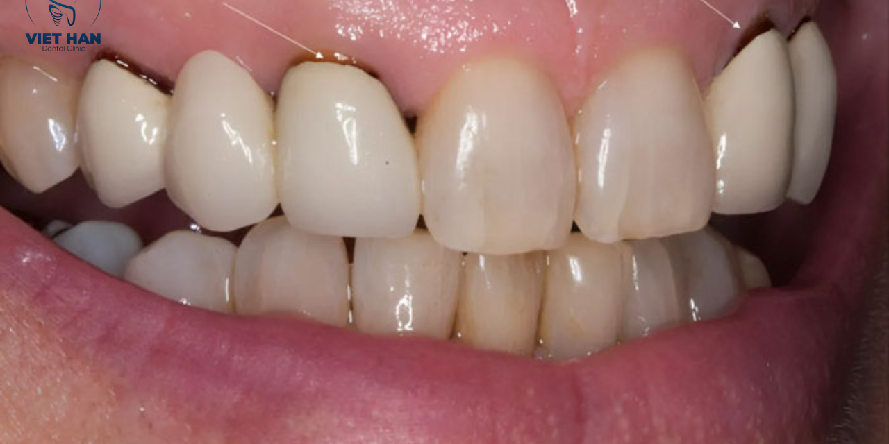 Niềng răng 1 hàm: Tiết kiệm chi phí nhưng có thật sự an toàn?