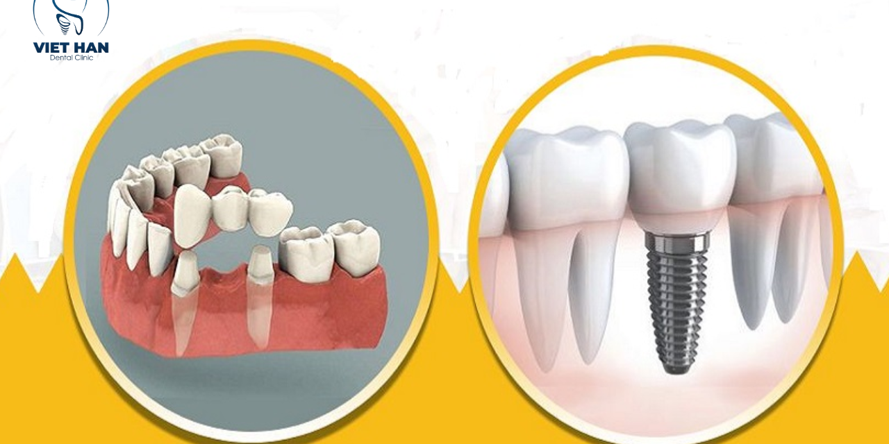 Nên trồng Implant trước hay bọc sứ trước nếu mất răng nhiều vị trí?