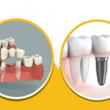 cầu sứ hay implant
