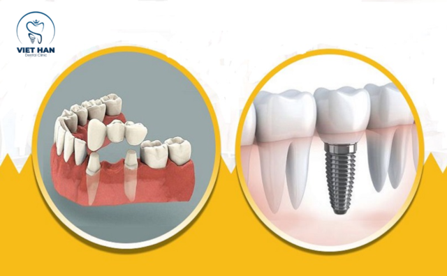 cầu sứ hay implant