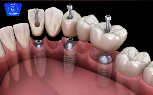 Ưu điểm khi trồng Implant