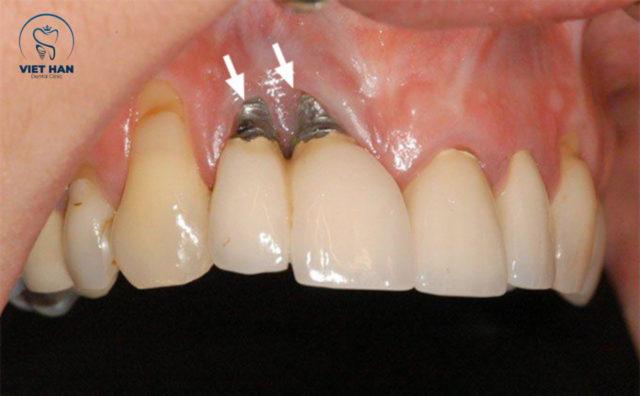 implant dao thai