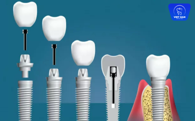 Nguyên nhân đào thải Implant