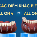 điểm khác biệt all on 4 và all on 6