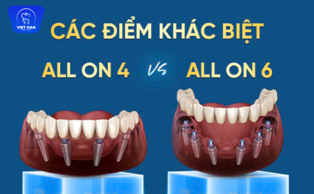 điểm khác biệt all on 4 và all on 6