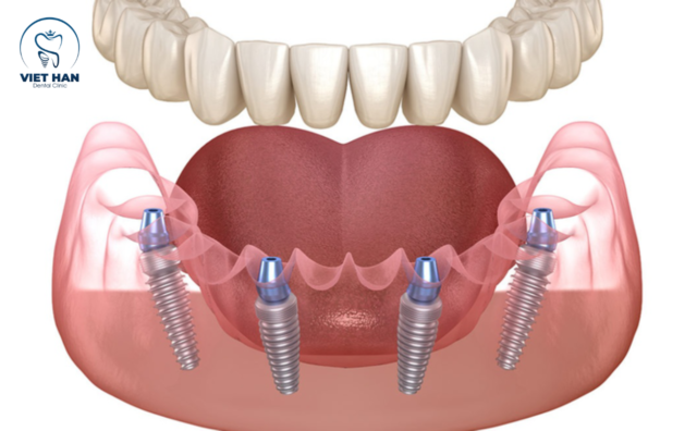 Trọ Implant All on 4