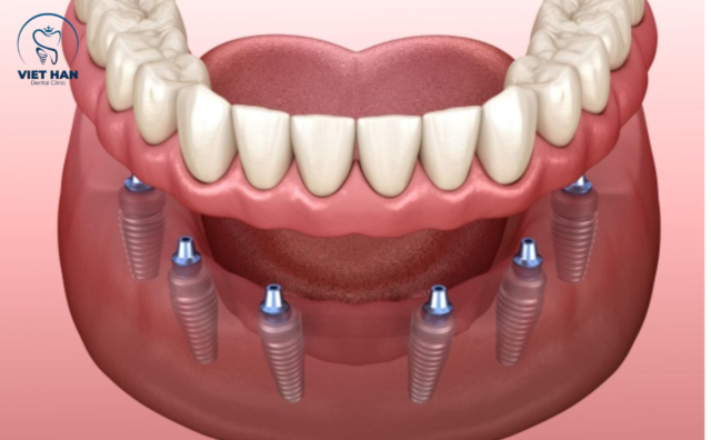Implant all on 6