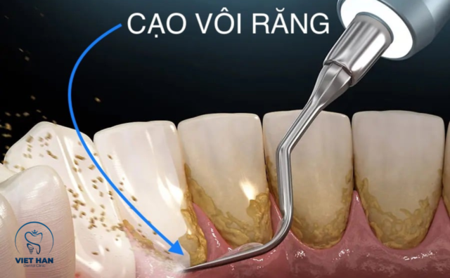 Bao lâu nên lấy cao răng một lần?