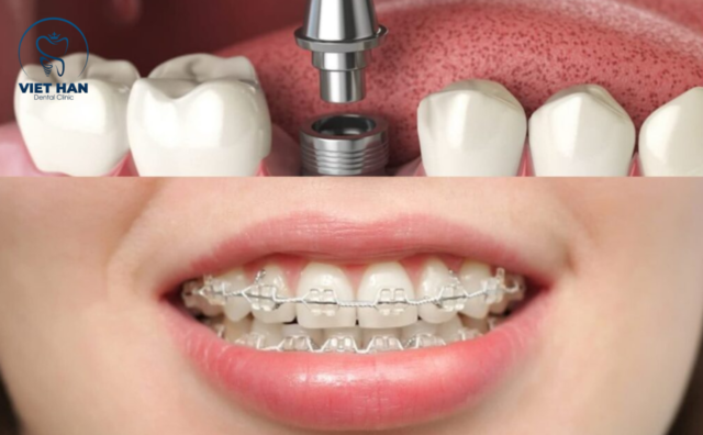 Trong quá trình niềng khi nào nên cắm implant?