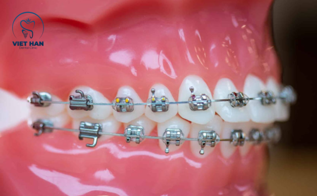 Ưu điểm niềng răng mắc cài 3M