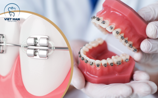 Niềng răng 3M - sự lựa chọn tối ưu 