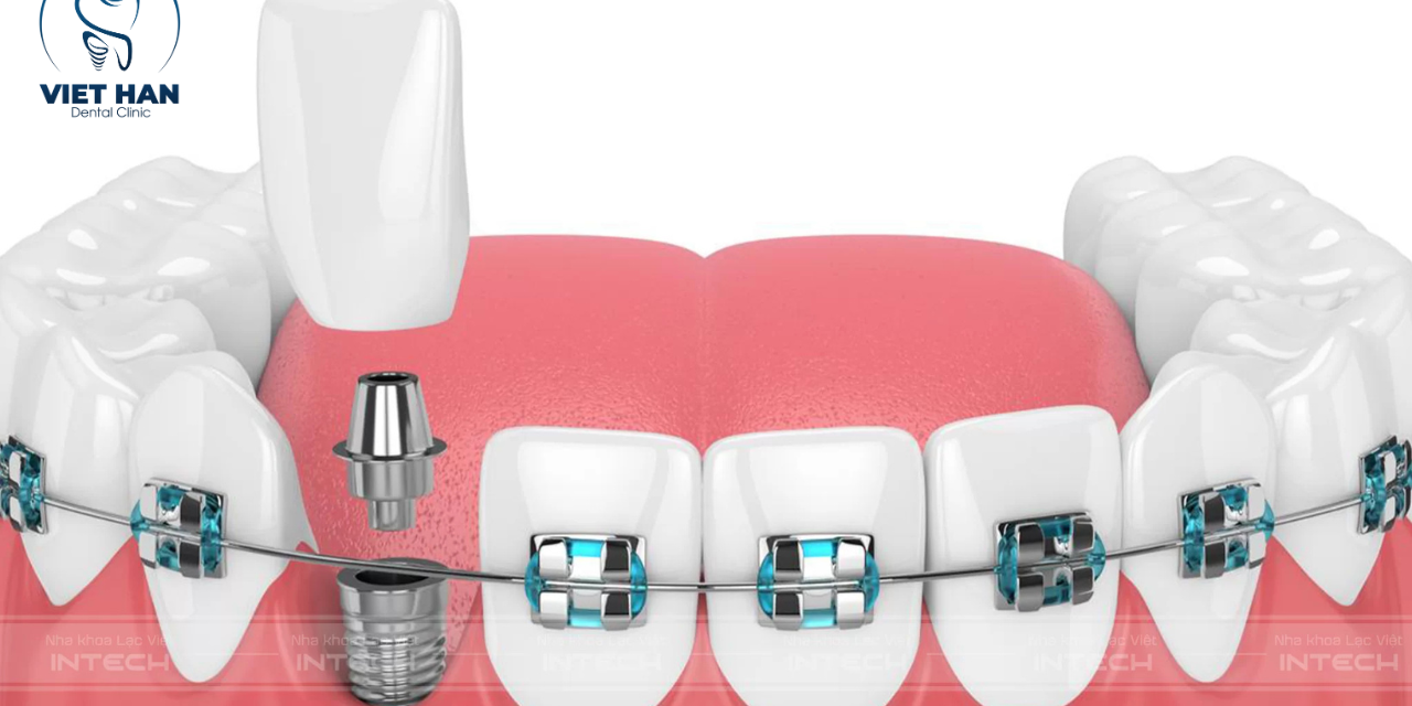 Trong quá trình niềng răng có cắm Implant được không?