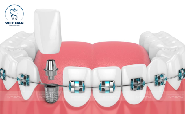 Niềng răng có cắm Implant được không?