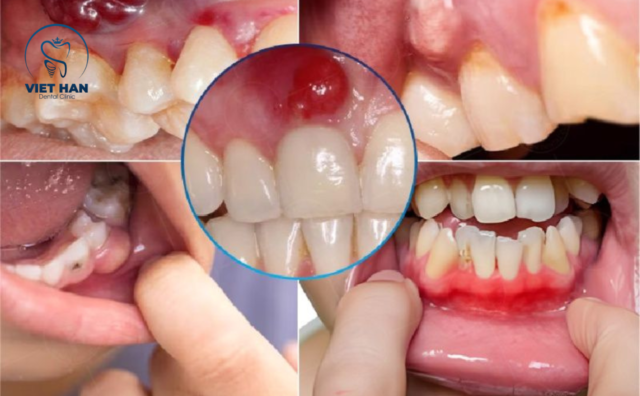 Khi nào không nên bọc sứ?