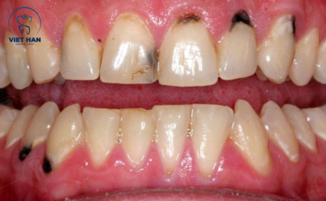 Vì sao viêm nha chu không nên bọc sứ?