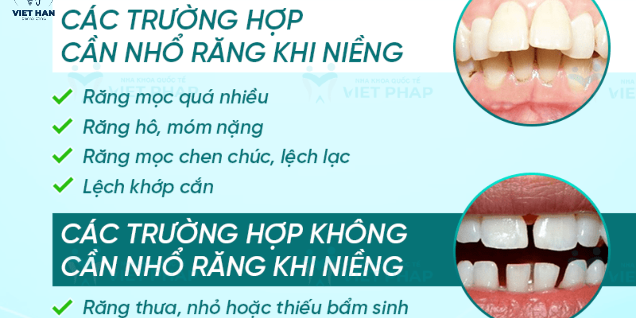 Nhổ răng khi niềng: khi nào cần, khi nào không?
