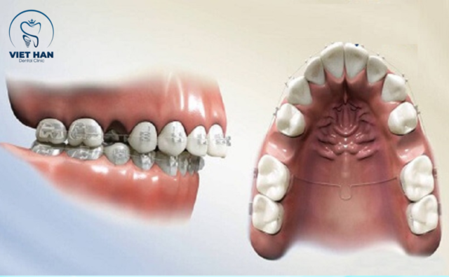 Nhổ răng khi niềng