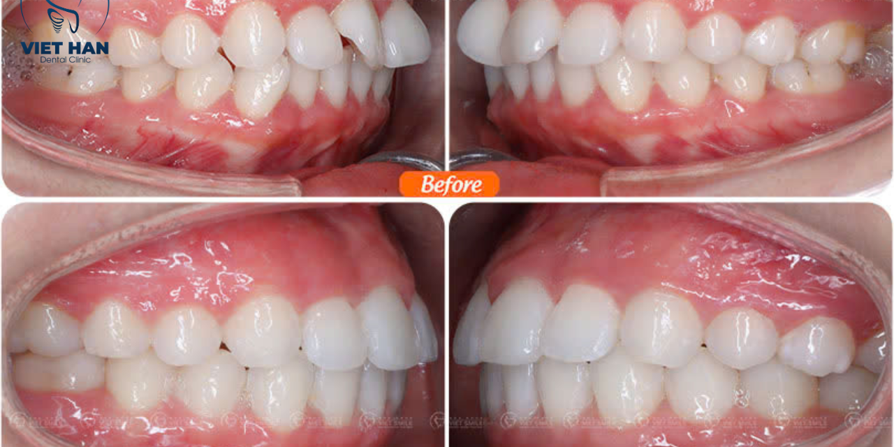 Cắt nướu có ảnh hưởng đến tốc độ niềng răng không?