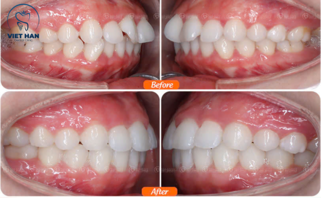 Cắt nướu có ảnh hưởng đến tốc độ niềng răng không?