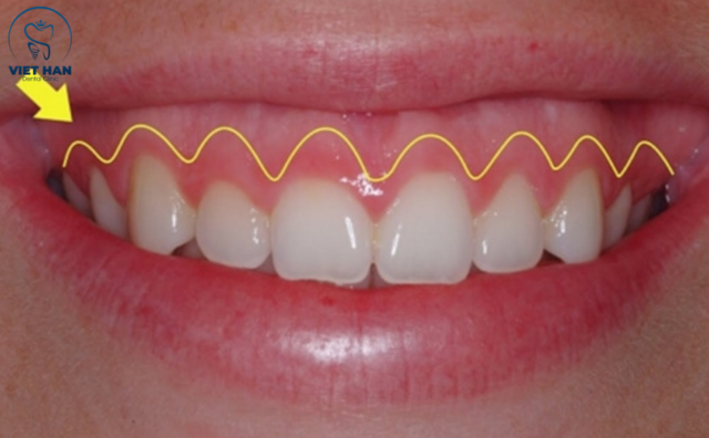 Cắt nướu có đau không?