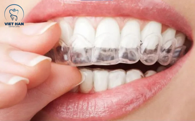 Cách đeo hàm duy trì đúng cách