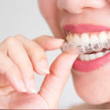 Hướng dẫn đeo khay trong suốt