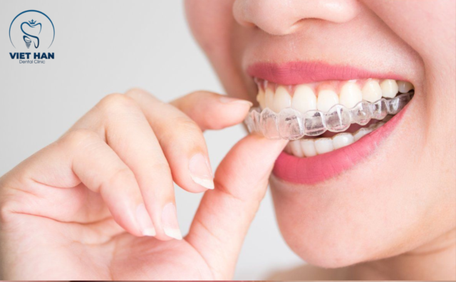 Hướng dẫn đeo khay trong suốt