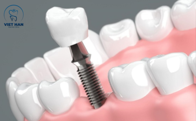 Ưu, nhược điểm của Implant tức thì