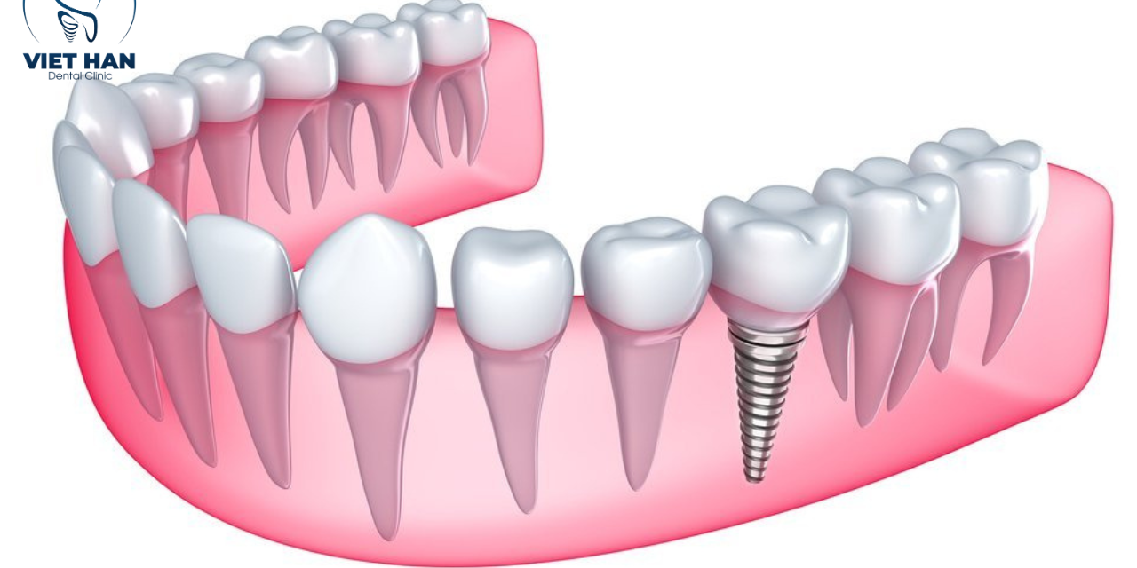 Implant tức thì: Nhổ răng xong cấy liền có an toàn không?