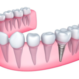 Ưu điểm của Implant tức thì