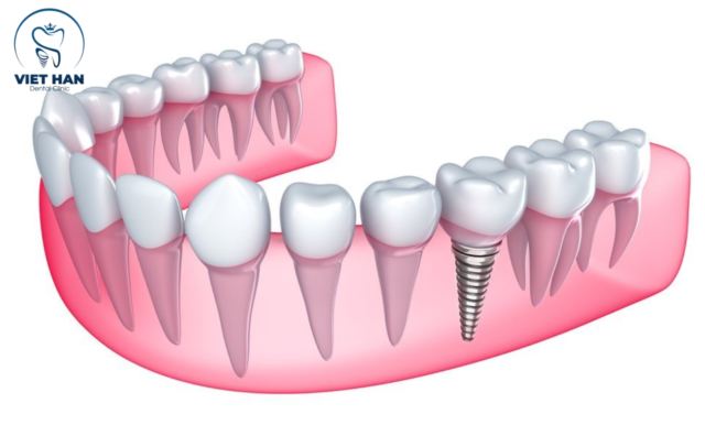 Ưu điểm của Implant tức thì