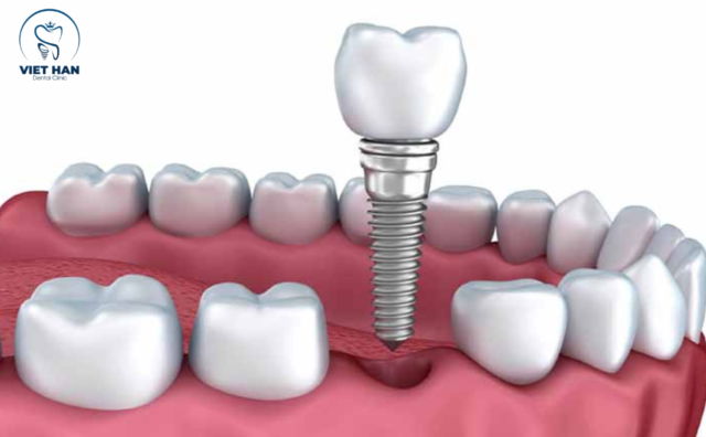 Implant tức thì là gì?