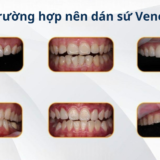Dán sứ Veneer cho răng