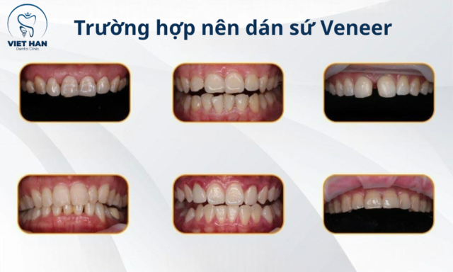 Dán sứ veneer cho răng thưa phù hợp với các trường hợp răng thưa, không đều, kém thẩm mỹ.