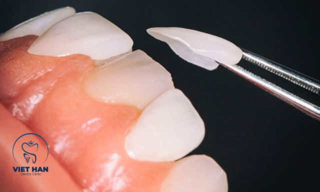 Quy trình dán sứ veneer cho răng thưa mang lại nụ cười đều đẹp, thẩm mỹ cao.