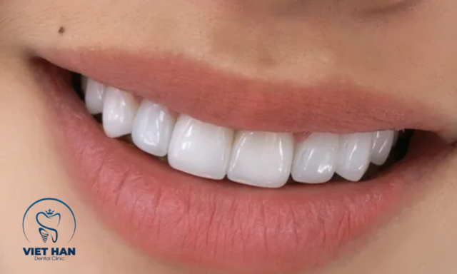Dáng răng sứ đẹp tự nhiên với form răng đều, màu trắng ngà trong nhẹ, hài hòa khuôn miệng và nụ cười.