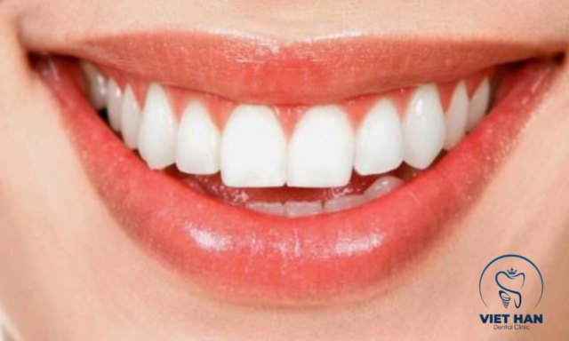 Cận cảnh hàm răng đều đẹp, bo viền mềm mại tạo dáng răng sứ đẹp tự nhiên.