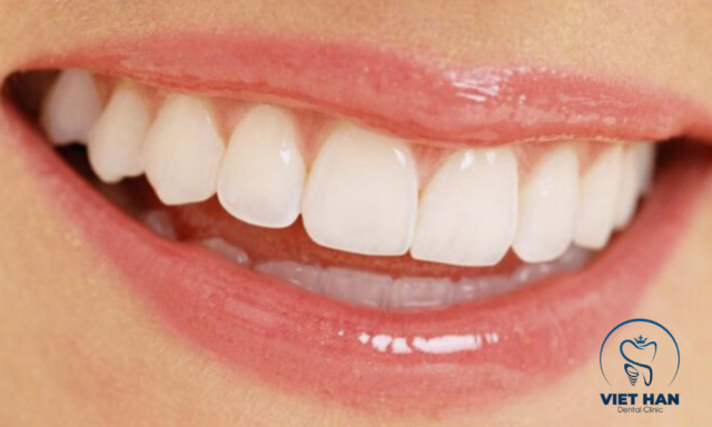 Hàm răng trắng sáng, cân đối từng chiếc, chuẩn dáng răng sứ đẹp tự nhiên.