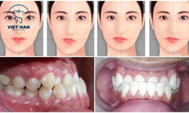 Những trường hợp nên niềng răng cải thiện mặt lệch
