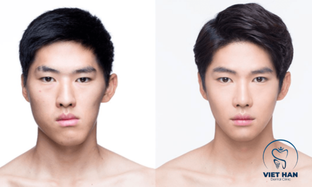 Khuôn mặt hài hòa sau niềng răng cải thiện mặt lệch.