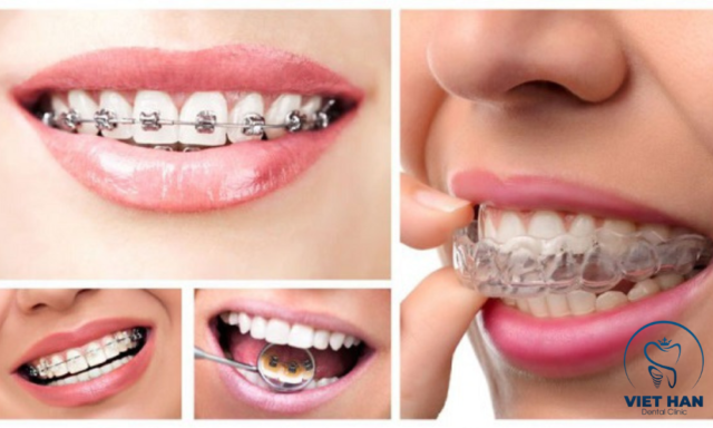 Các phương pháp niềng răng cải thiện mặt lệch.