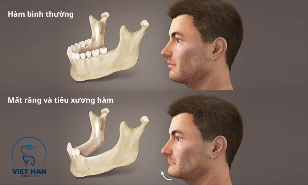 Tiêu xương hàm khi mất răng: Những điều cần biết trước khi cấy Implant