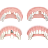 Trồng implant răng cửa giúp phục hình chân răng vững chắc, gắn mão sứ tự nhiên, ăn nhai và thẩm mỹ như răng thật.